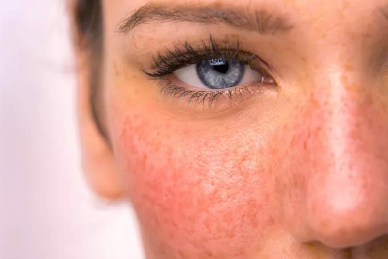 Natural treatments for rosacea.