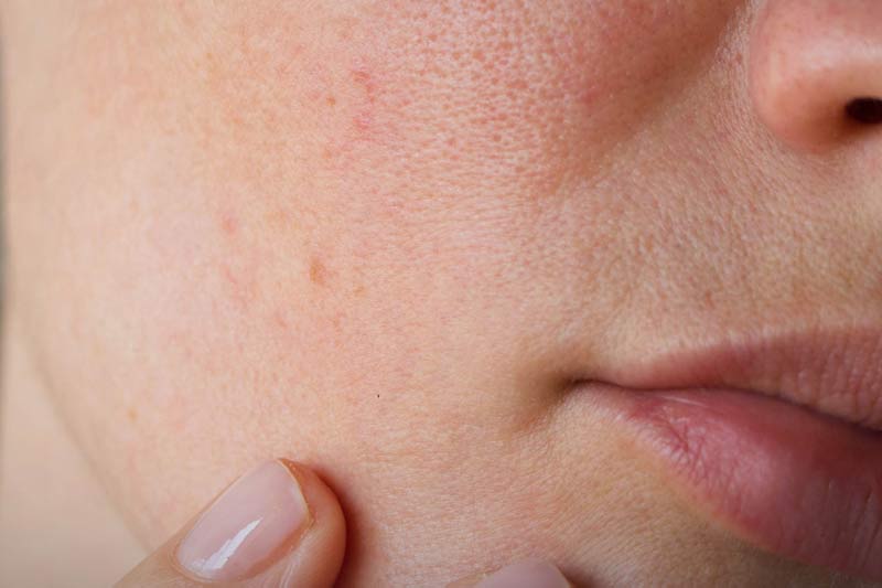 PCOS Acne: Definition, Diagnosis, Management