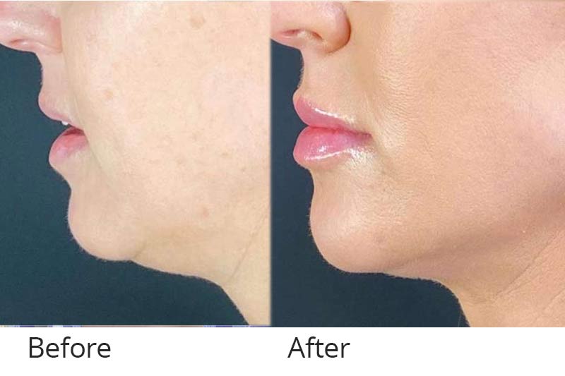 Before and after a liquid facelift.