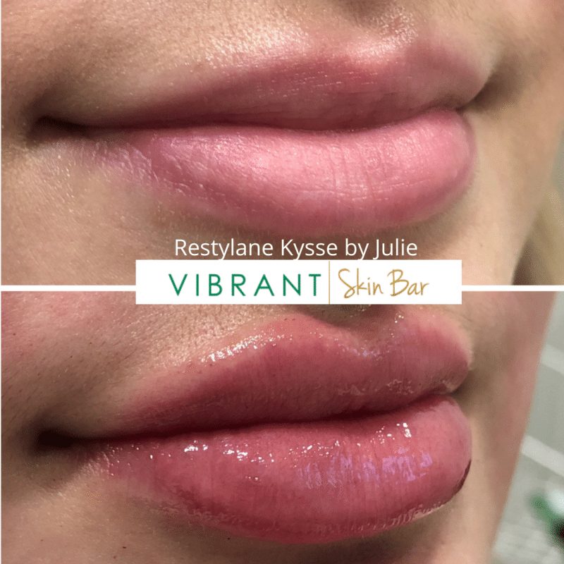 Everything You Need to Know About Hyaluronic Acid Lip Fillers