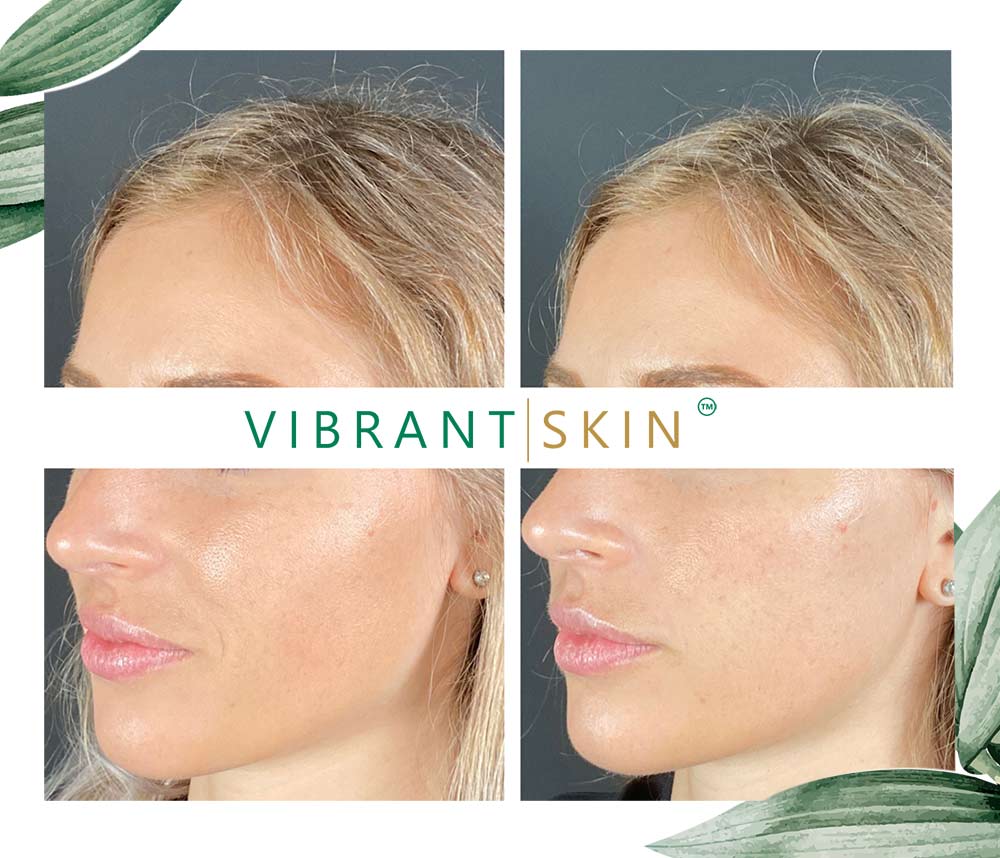 before and after fillers for nasolabial folds 