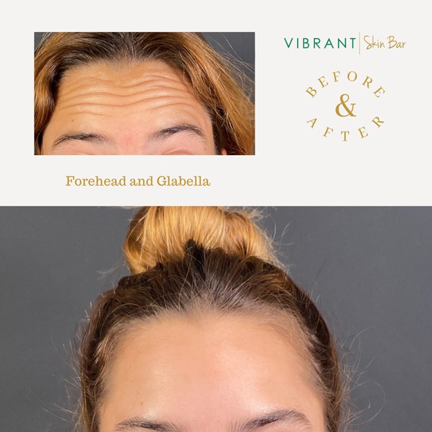 Forehead Botox before and after image.