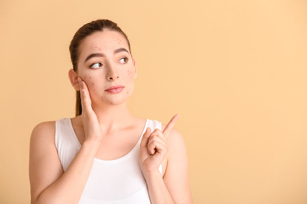 What causes acne?