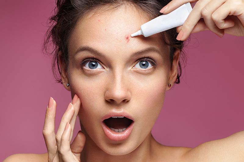 What is acne?