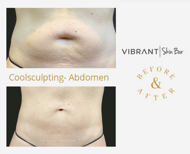 CoolSculpting the abdomen - before and after results.