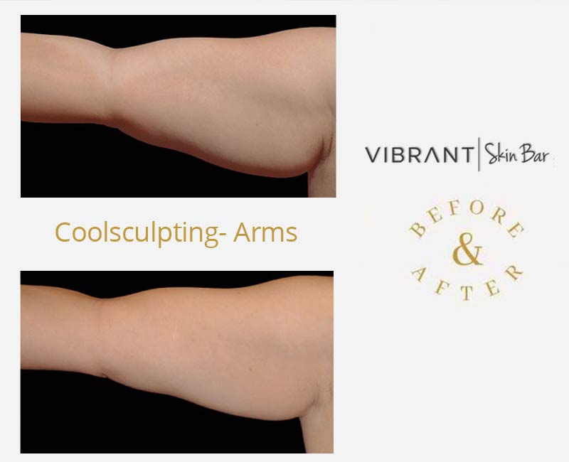 CoolSculpting the arms - before and after results.