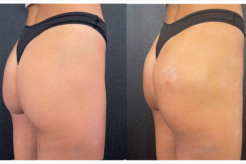 Nonsurgical butt lift results.