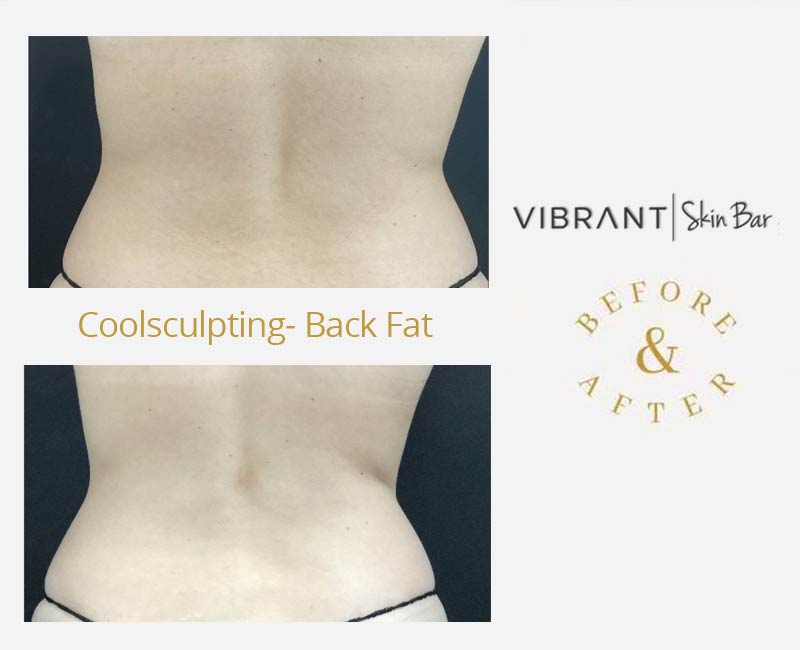 CoolSculpting back fat - before and after results.