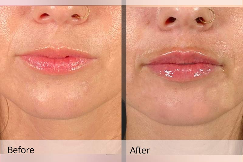 Temporary lip filler results and longevity