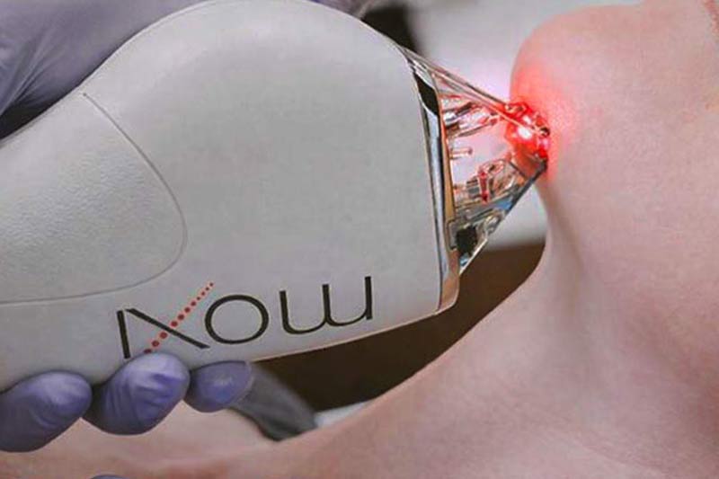 MOXI laser procedure.