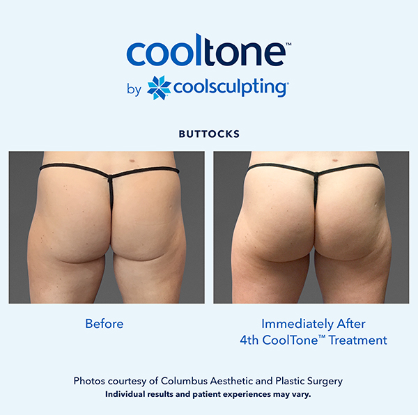 Cooltone before and after in a female's buttocks
