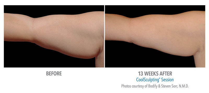 CoolSculpting arms before and after