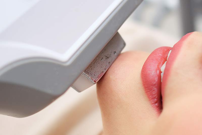 Does MOXI Laser Hurt?