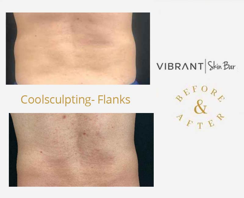 CoolSculpting the flanks - before and after results.