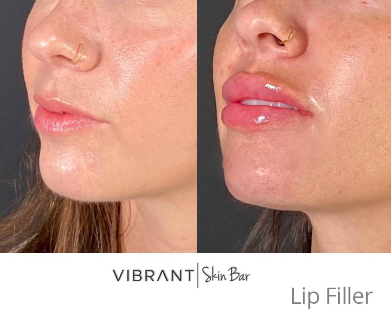 Lip filler before and after.