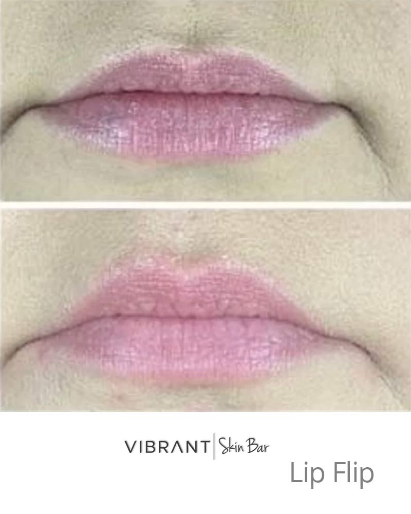 Lip flip before and after.