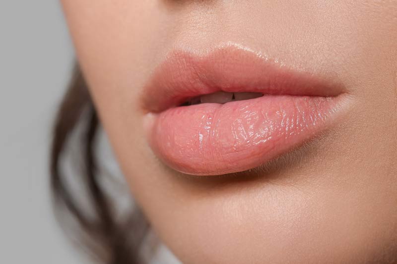 Lip filler migration: causes, symptoms, and treatment.