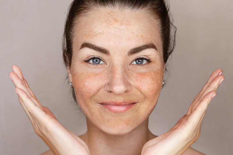 MOXI Laser for Melasma: How Does It Work?