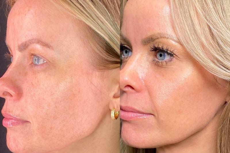 Moxi results - before and after.