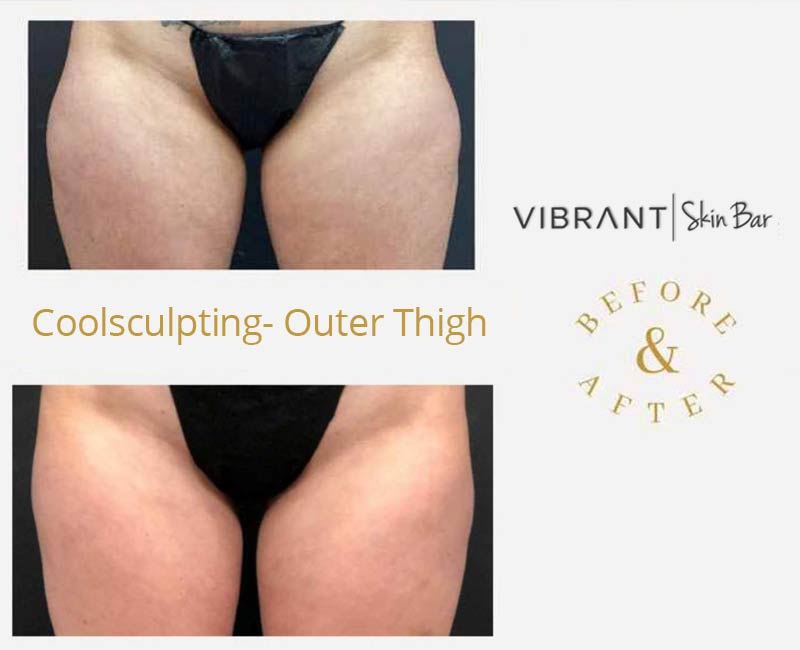 CoolSculpting the thighs - before and after results.