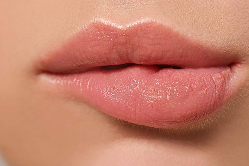 Overfilled lip filler.