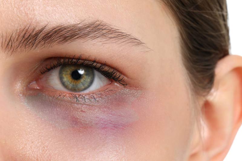 The Tyndall Effect after Dermal Fillers: What Is It and How to Avoid It?