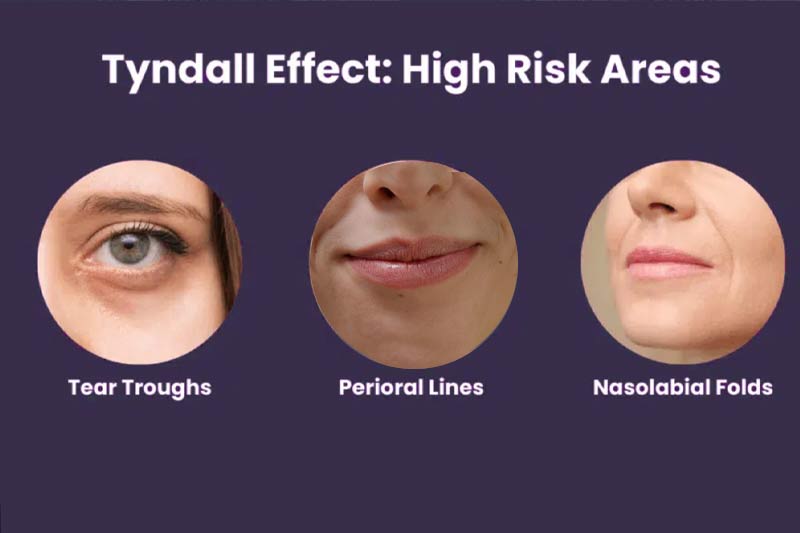 Tyndall Effect: High-Risk Areas