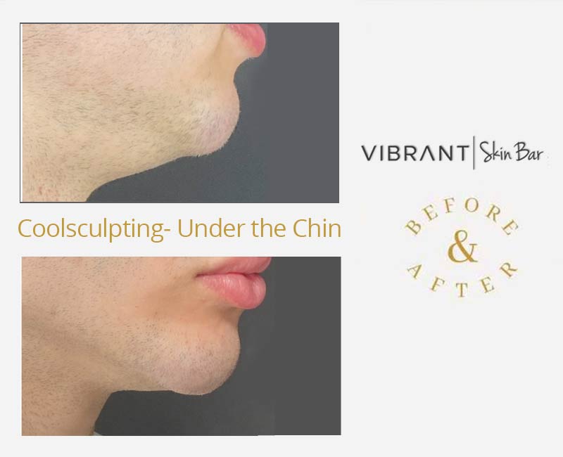 CoolSculpting under the chin - before and after results.