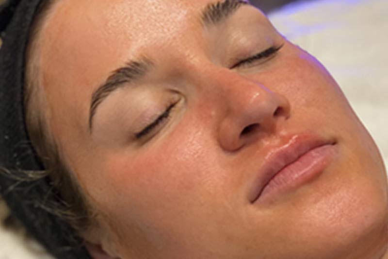 Results of chemical peels for acne scars