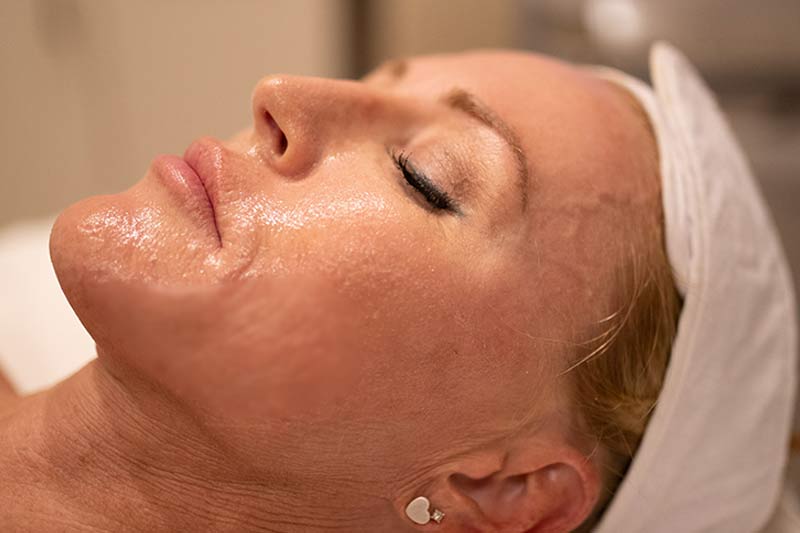 After hydrafacial