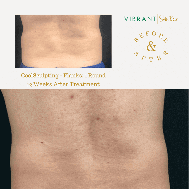 Before and after image for CoolSculpting back fat