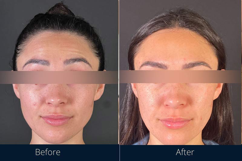 Before and after face slimming Botox