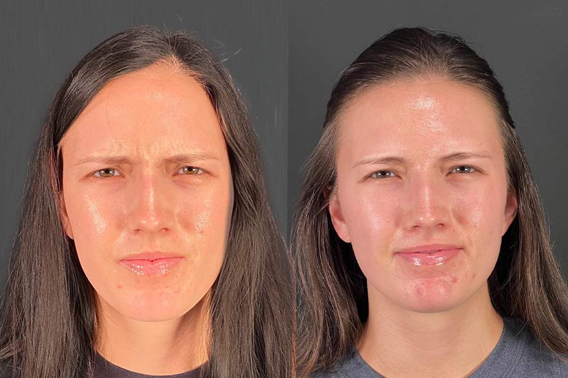 Before and after Botox