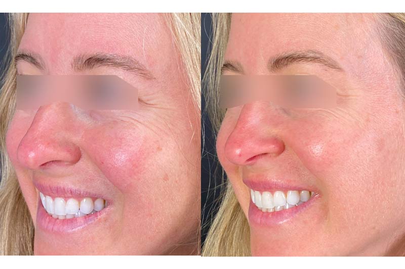 Before and after Dysport