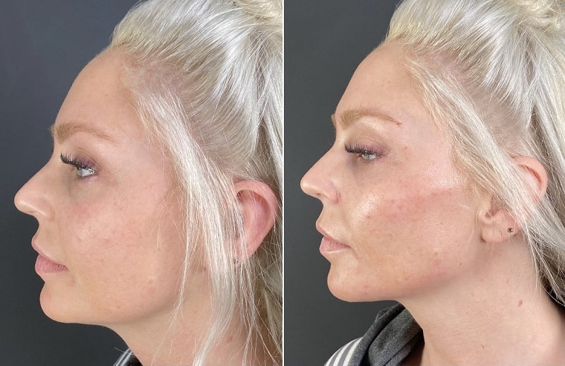Before and after dermal filler for the jawline