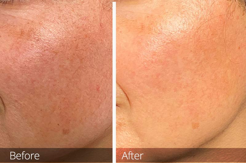 NanoLaserPeel results