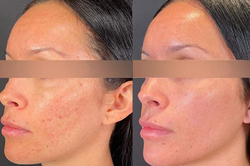 Before and after microneedling