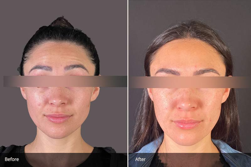 Before and after nose Botox