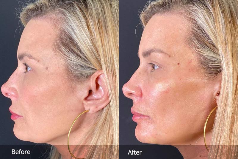 Before and after Sculptra filler