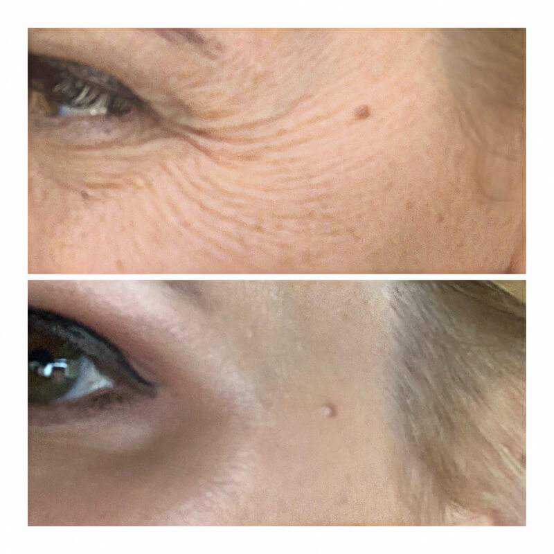 Results before and after Botox for crow's feet