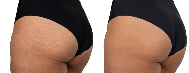 Before and after microneedling stretch marks
