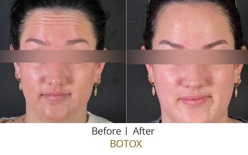 Before and after results of Botox.