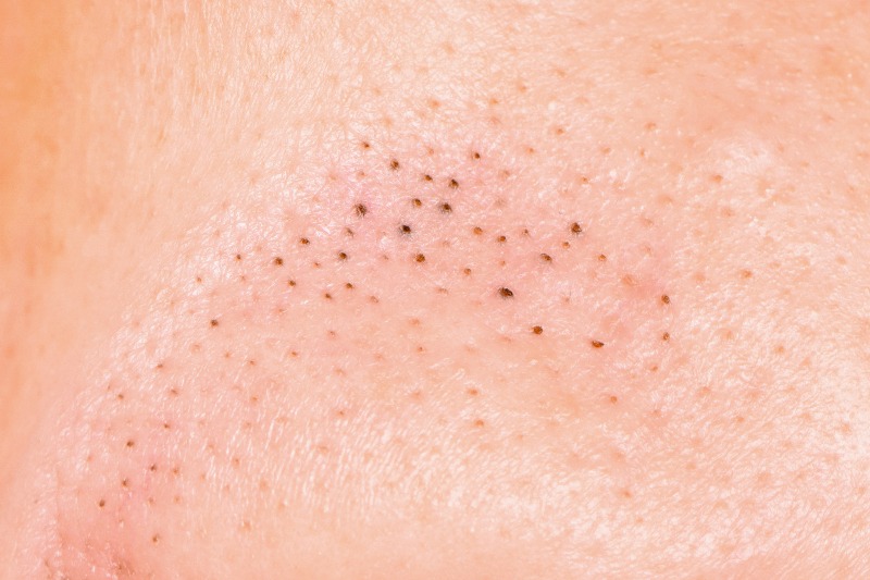 Blackheads are mild, non-inflammatory type of acne.