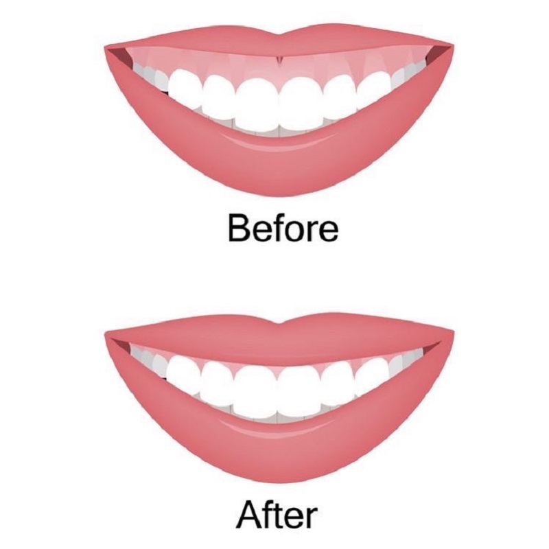 Before and after Botox for gummy smile treatment