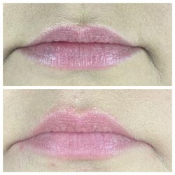 Botox in Phoenix before and after 4