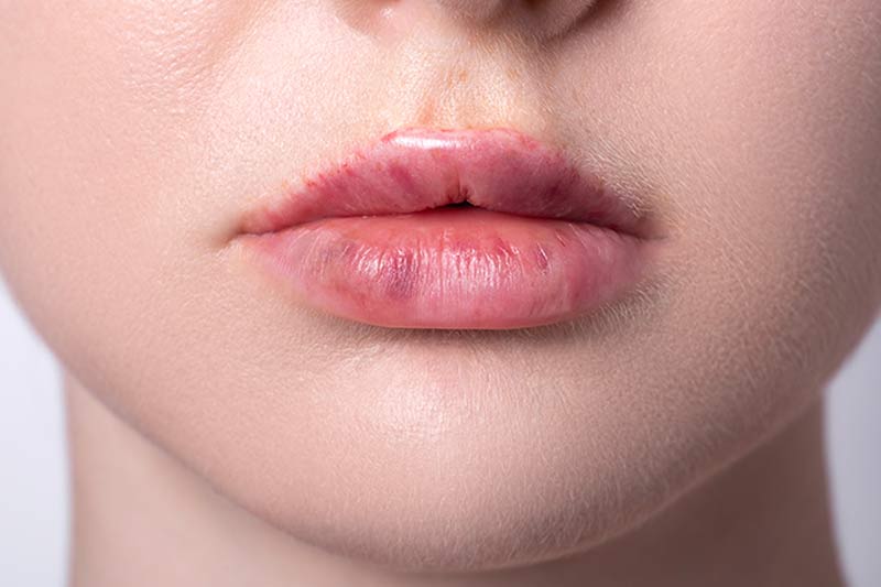 Bruising after lip filler