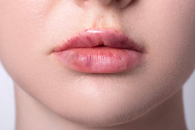 Abnormal Bruising After Lip Filler Infoupdate