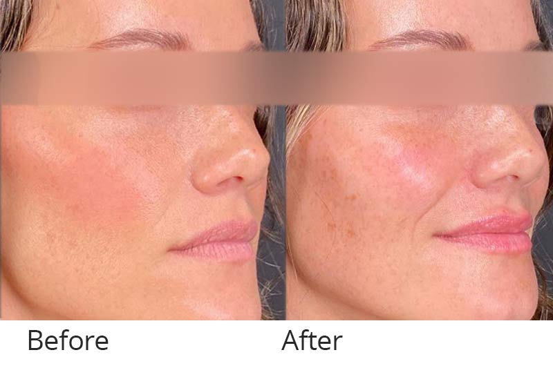 Before and after a cheek filler