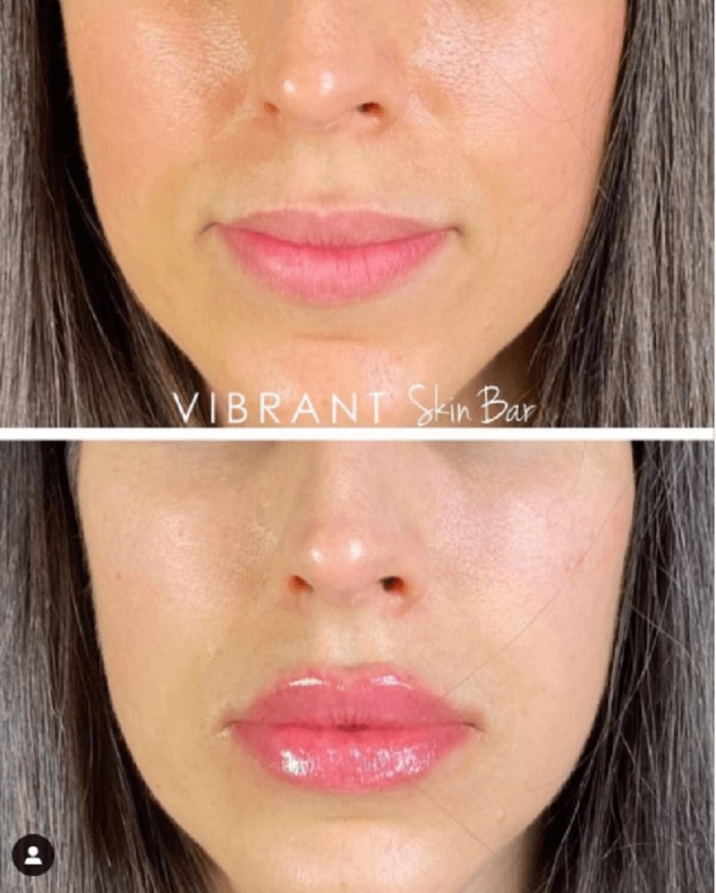 Before and after cheek fillers