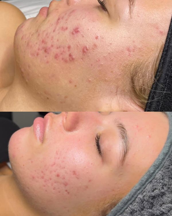 Chemical peel - before and after photo